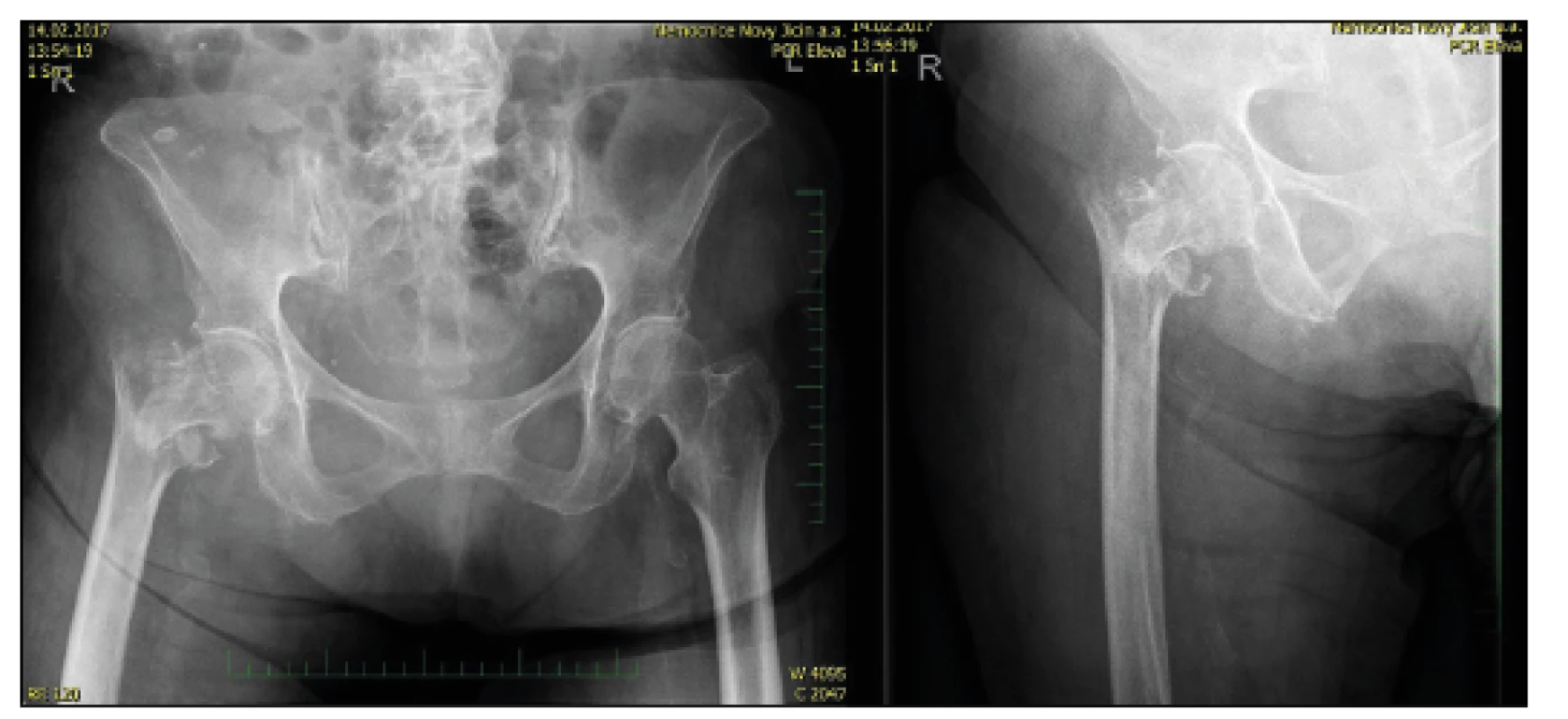 87-year-old female with pathological fracture of the trochanteric
massive, trauma X-ray