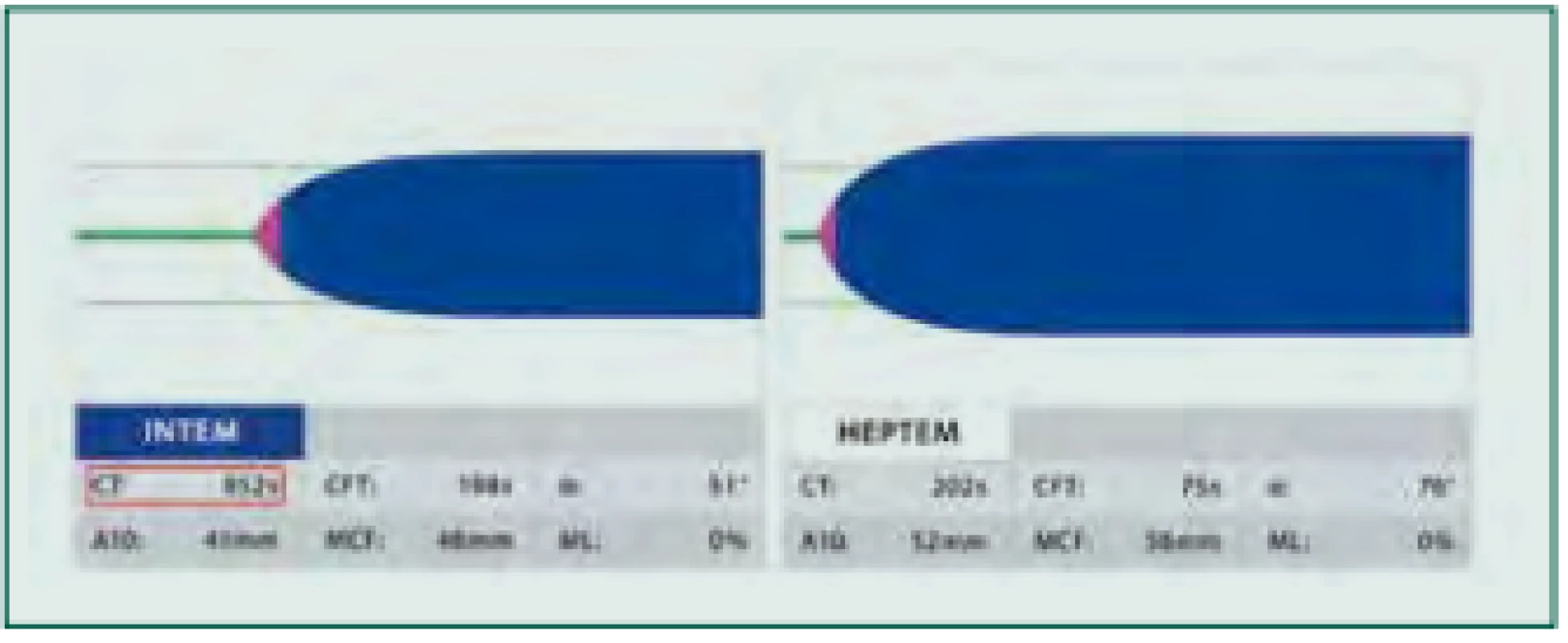 Vliv heparinu: Provedený test INTEM s patologicky prodlouženým
parametrem CT (červený rámeček, normální hodnoty 100–240 s) značí jednak
deficit koagulačních faktorů, ale může znamenat též vliv heparinu. K odlišení
je proveden test HEPTEM s heparinázou. Normalizace parametru CTHEPTEM
potvrzuje vliv heparinu a v terapii tak přichází v úvahu protamin. Pokud je
tento parametr patologický, je nutné substituovat koagulační faktory