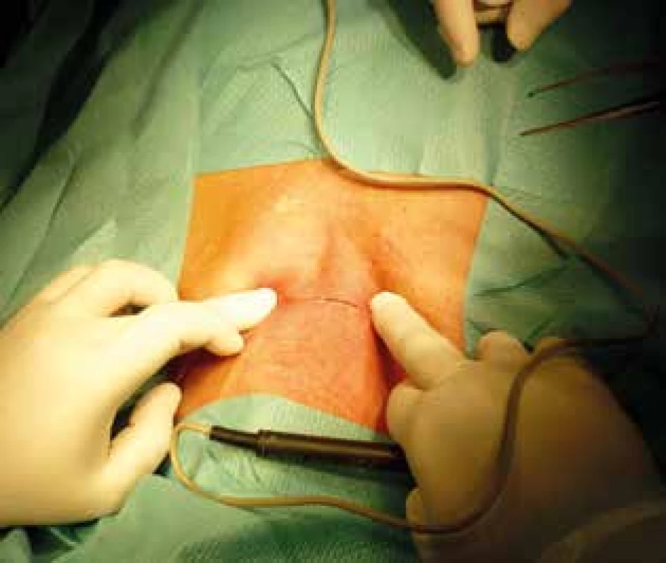 Cervikálna fáza – naznačená krčná incízia<br>
Fig. 1: Cervical phase – cervical incision