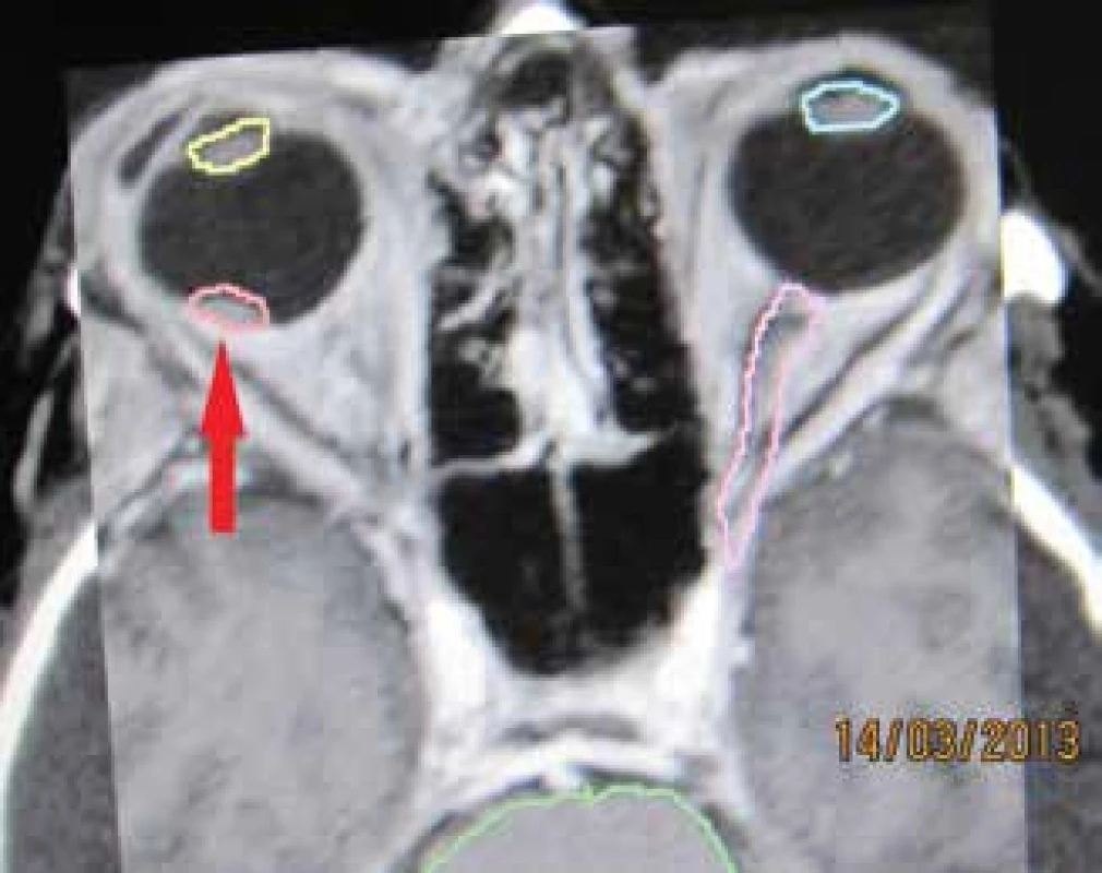Nádorové ložisko – melanóm choroidey
v štádiu T1 - v blízkosti makuly zakreslené pred stereotaktickým
ožiarením v r. 2013 – červená šípka