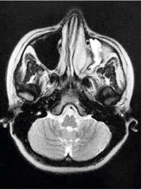 Předoperační MRI hlavy a vedlejších nosních dutin (VND) v T2 – váženém obrazu, axiálně projekce - hypoplázie a opacifikace levé čelistní dutiny (*). 