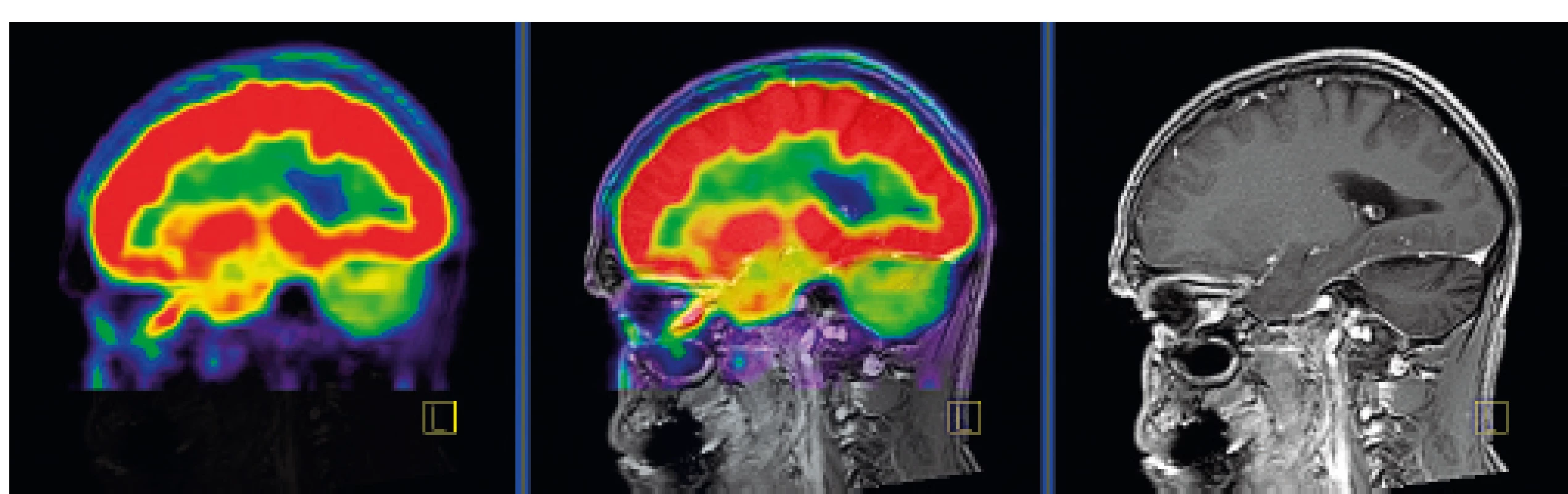 PET CT zobrazení mozku, červená barva znázorňuje intenzivní
akumulaci fluorodeoxyglukózy (FDG), zatímco zelená barva odpovídá
snížené akumulaci FDG<br>
V oblasti cerebella, které je postiženo neurodegenerativními změnami,
je zřetelné snížené vychytávání FDG a neurodegenerativní změny byly
u tohoto pacienta zřetelné i na MR zobrazení.