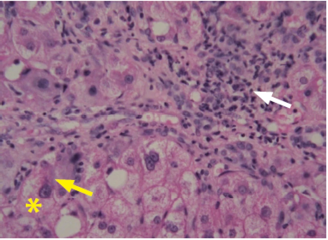 Steatohepatitida způsobená ALD. Na obrázku jsou zobrazeny znaky poškození hepatocytů – balónová degenerace (*), Malloryho hyalin (žlutá šipka), kulatobuněčný infiltrát (bílá šipka)