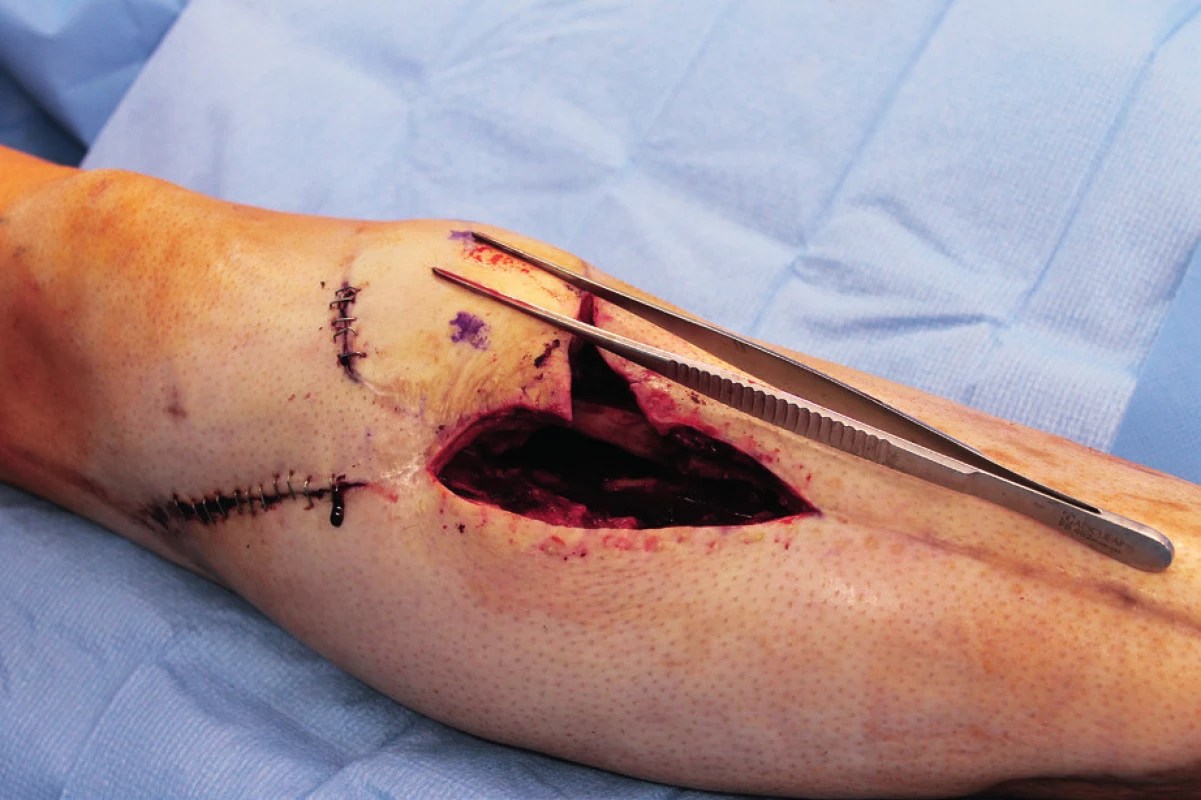 LCP proximal tibia plate was removed and a radical
debridement was performed after marking all fistula folds with
patent blue marker