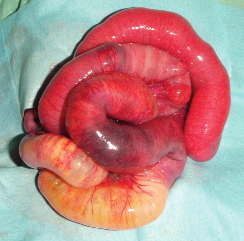 Peroperační nález střevní nekrózy u NEC.<br>
Fig. 2. Intestinal necrosis in surgically treated patient.