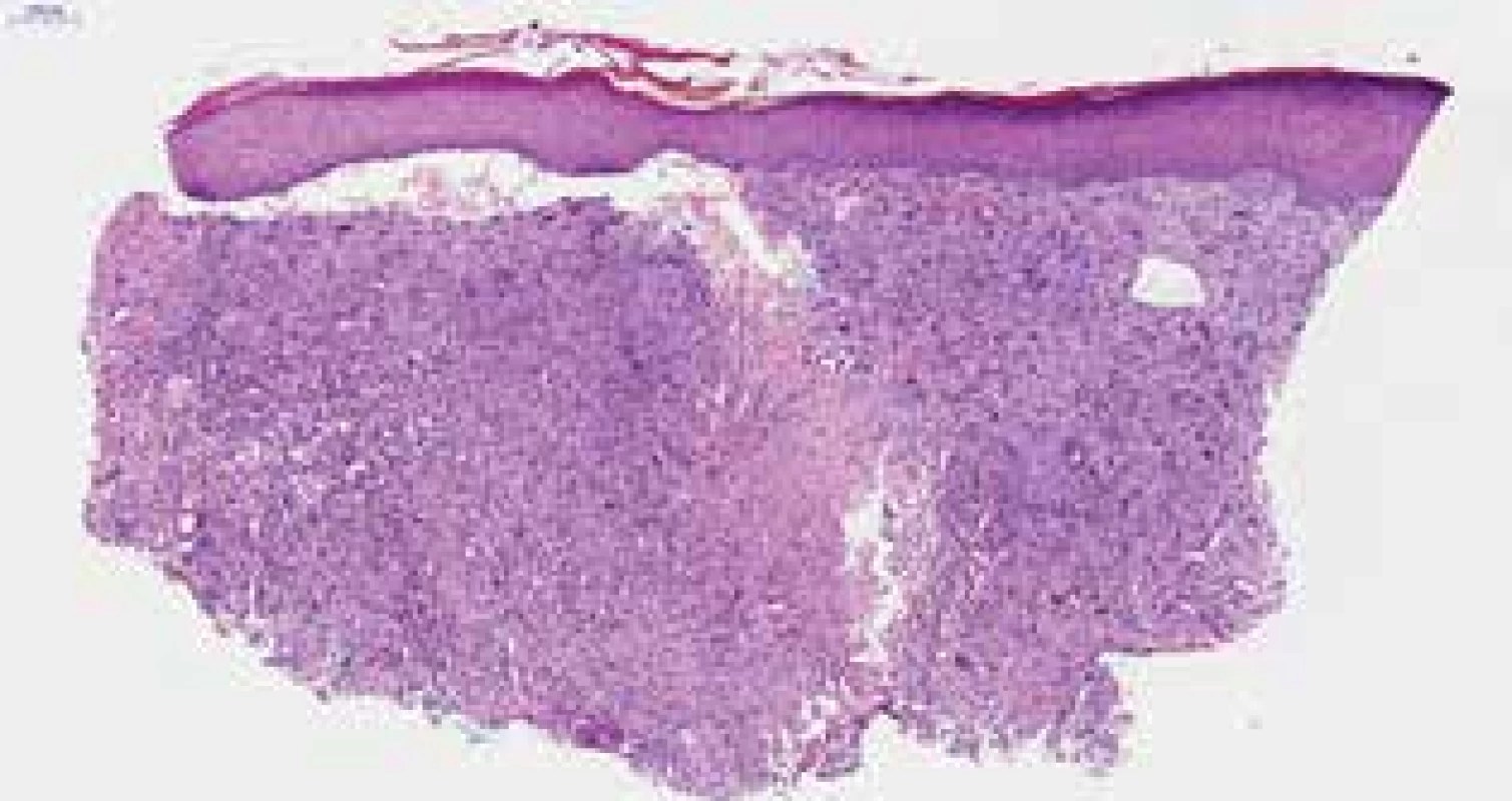 Pleomorfní vřetenobuněčná nádorová proliferace postihující celou dermis (hematoxylin-eosin, 40krát)