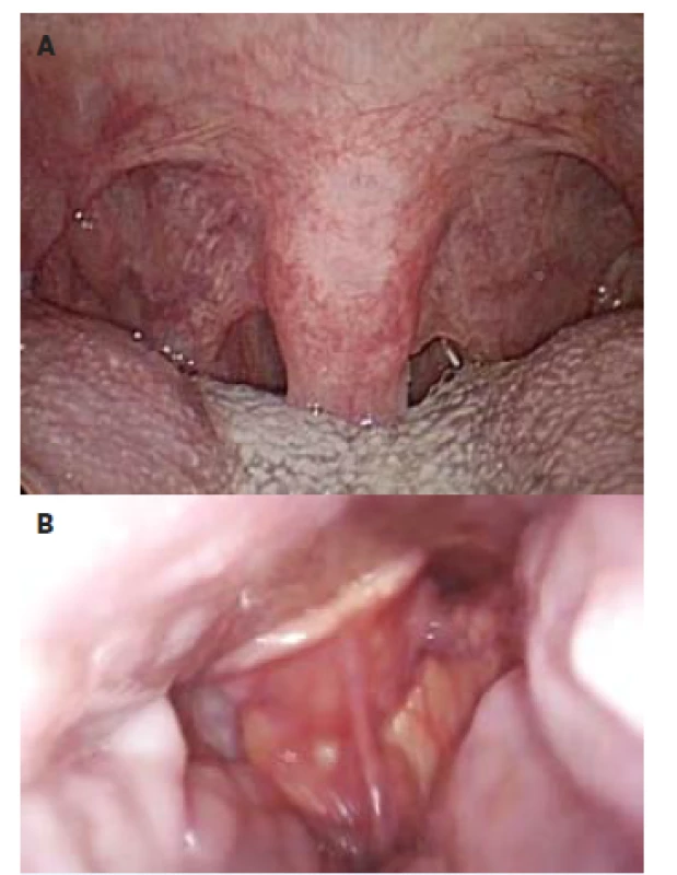 Nejčastější příčiny obstrukce HCD ve spánku:<br>
a) pokles zadních patrových oblouků a prodloužená uvula<br>
b) kolabující <i>epiglottis</i>