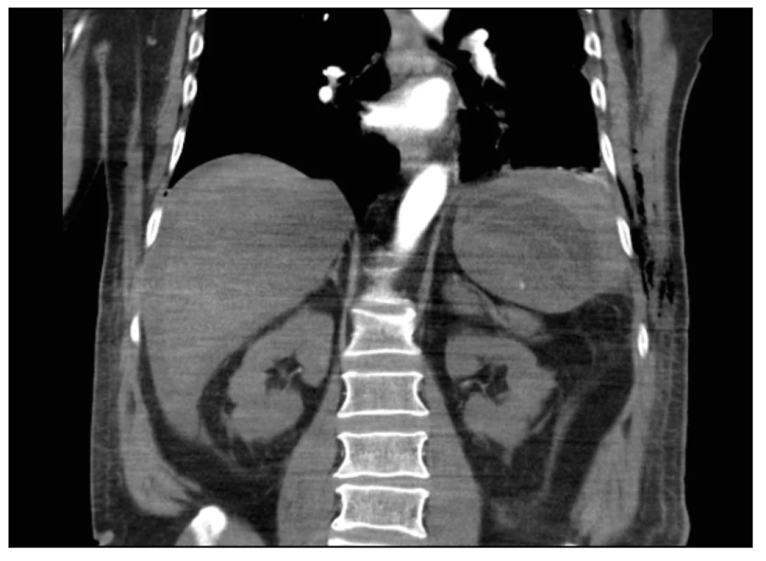 CT trupu po KPR. Koronární řez. Ruptura sleziny s hemoperitoneem, v arteriální fázi s patrným leakem KL