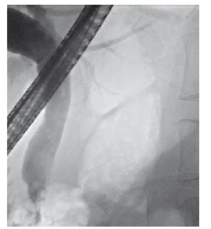 Endoskopická retrográdní
cholangiopankreatikografi e – v distálním
choledochu defekt v náplni
10 × 10 mm, retrostenostická dilatace.