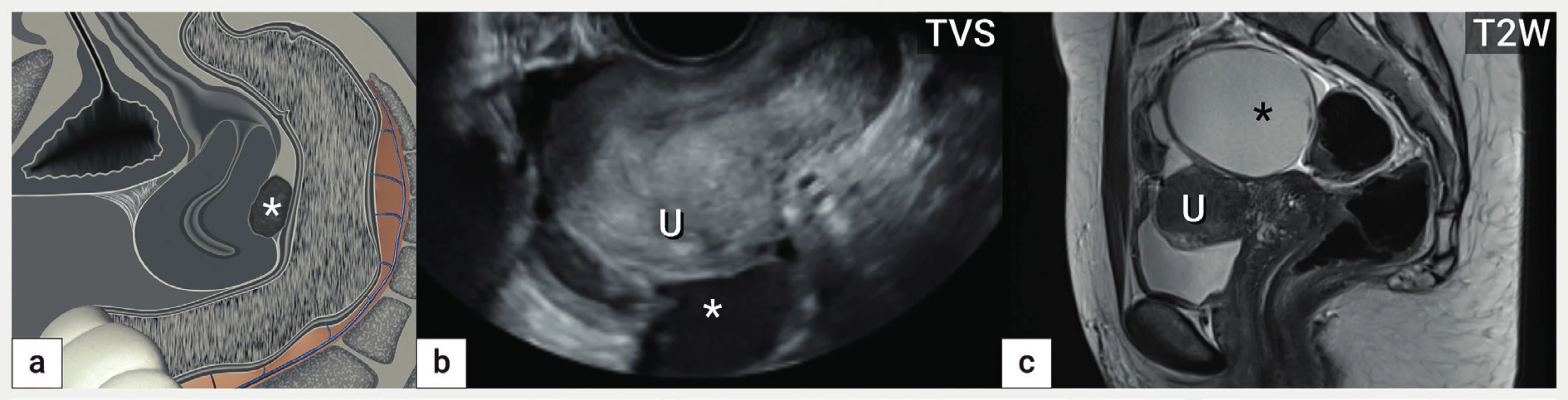 Děloha tvaru otazníku<br>
Schéma obliterace pánve s patrnou dělohou tvaru ‚otazníku' na podkladě adhezí zadní stěny děložní k endometroidní cystě (hvězdička),
zároveň přítomny srůsty obliterující vezikouterinní pliku (a), ultrazvukový obraz dělohy s pevnou adhezí zadní stěny k endometroidní cystě
(hvězdička) (b), magnetická rezonance obliterovaného Douglasova prostoru na podkladě fixace dělohy k velké cystě (hvězdička) (c).
U – uterus, TVS – transvaginální sonografie, T2W – T2 vážené obrazy v magnetické rezonanci