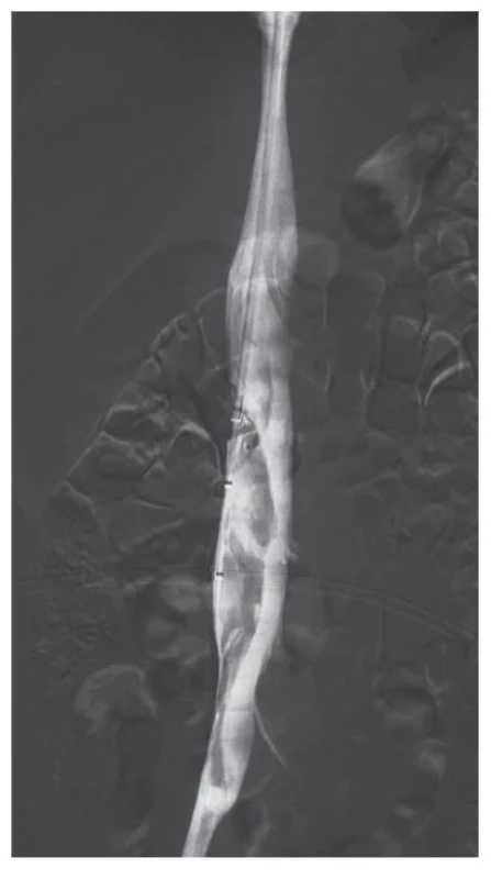 DSA,
defekt v náplni
dolní
duté žíly
odpovídající
trombóze