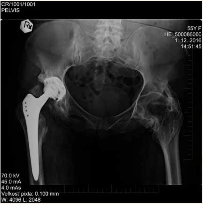 Stav riešený implantáciou totálnej endoprotézy pravého bedrového kĺbu s použitím závitoreznej jamky