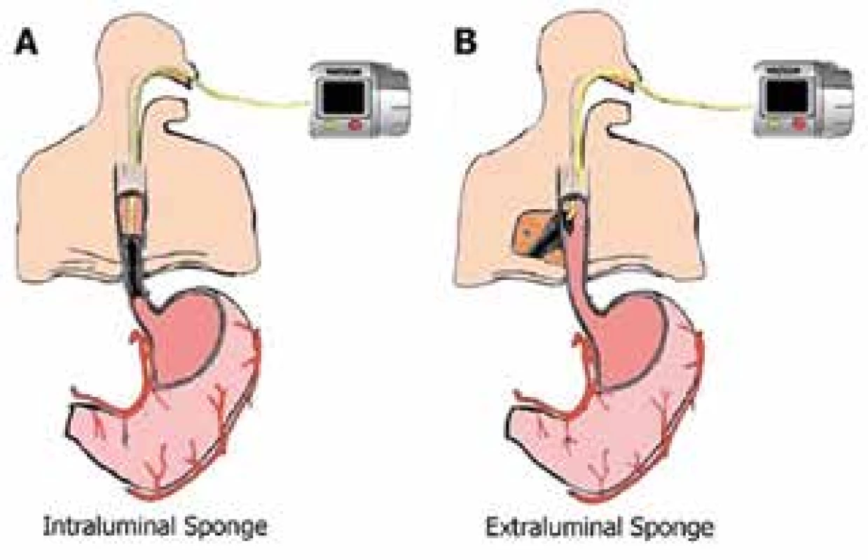 Endo-sponge: A- intraluminálne umiestnenie, Bintrakavitárne umiestnenie<br>
Fig. 2: Endo-sponge: A- intraluminal placement, B- intracavitary placement