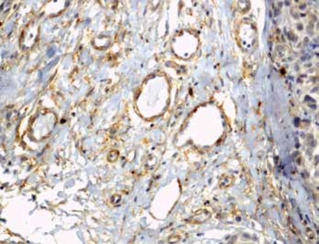 Imunohistochemický průkaz protilátky anti-CD90 v novotvořených
kapilárách na periferii tumoru (zvětšení 200x).