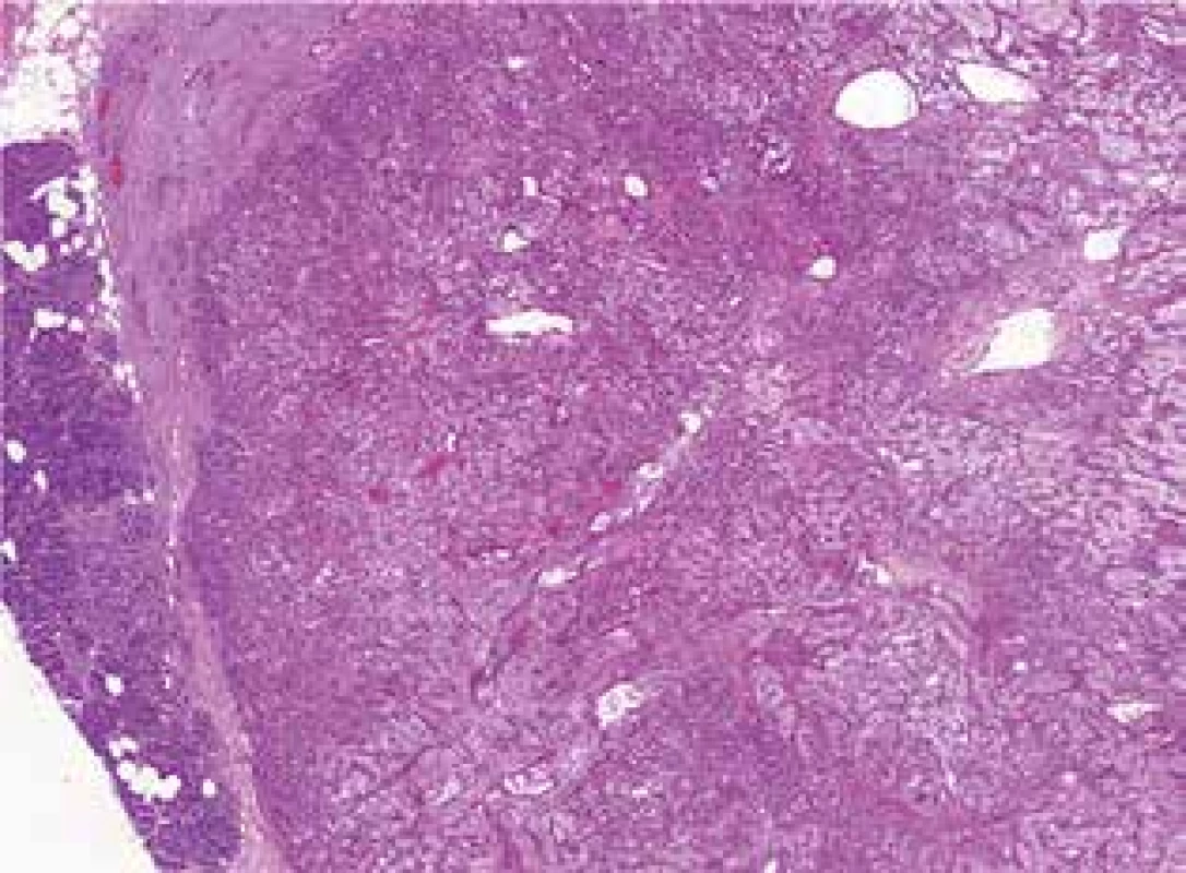 Metastáza světlobuněčného karcinomu ledviny
do pankreatu v CT obraze<br>
Fig. 3: Glandular tissue of the pancreas infiltrated by
metastatic water-clear cell renal carcinoma