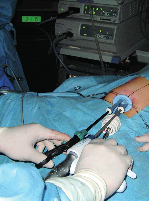 Laparoskopická operácia cez jeden vstup.<br>
Fig. 4. SILS (Single Incision Laparoscopic Surgery).