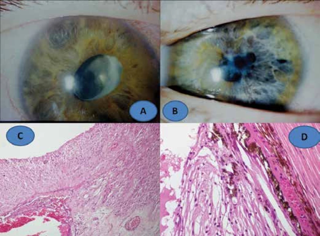 Clinical finding of phacoantigenic uveitis in 14 year old girl: right eye (A), left eye (B),
histological finding: fibrotised ciliary body with gliosis of detached retina, enlargement 100x,
HE (C), gliosis of retina and fibrotisation of choroid, enlargement 400x, HE (D)