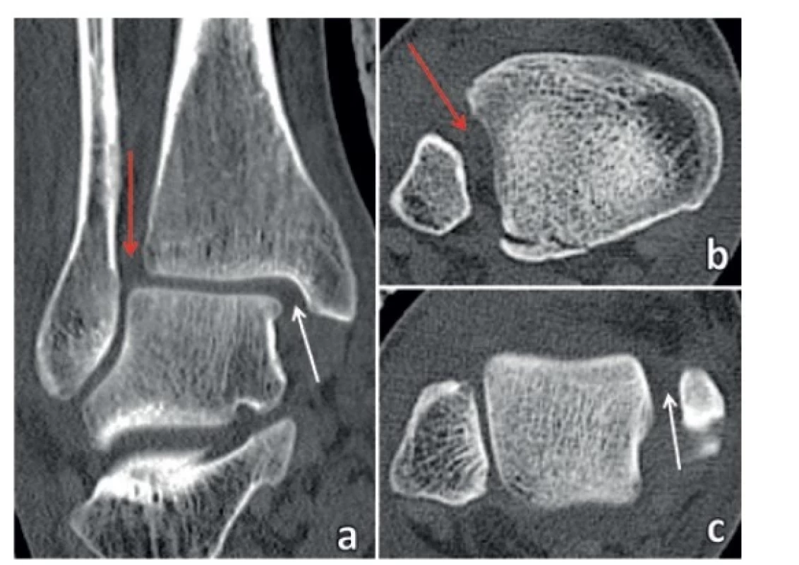 MZ na CT<br>
Rozšíření tibiofibulární vidlice (červená šipka) a zevní rotace
distální fibuly svědčí o ruptuře lig. tibiofibulare anterius a lig.
tibiofibulare interosseum, rozšíření „medial clear space“ (bílá
šipka) je známkou ruptury hluboké porce lig. deltoideum, fibulotalární
artikulace je intaktní. a – frontální sken, b – transverzální
sken 5 mm nad kloubní štěrbinou ukazuje odlomení
MP typ 2 B-R klasifikace, c – transverzální sken 5 mm pod
kloubní štěrbinou ukazuje rozšíření „medial clear space“.<br>
Fig. 2: MF on CT<br>
Widening of the tibiofibular mortise (red arrow) and external
rotation of the distal fibula indicate rupture of the anterior
tibiofibular and the interosseous tibiofibular ligaments; widening
of the “medial clear space” (white arrow) is a sign of rupture
of the deep part of the deltoid ligament; fibulo-talar articulation
is intact. a – frontal scan, b – axial scan 5 mm above
the joint line shows avulsion of MP of type 2 of B-R classification,
c – axial scan 5 mm below the joint line shows widening
of the “medial clear space”.