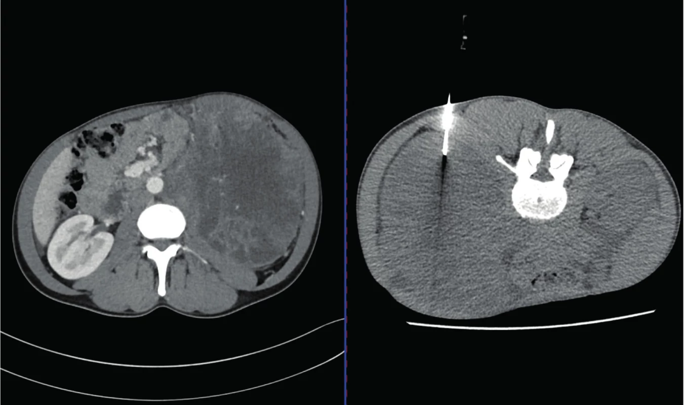 CT, transverzální řez. Muž, 35 let. Vlevo snímek CT před biopsií s popisem objemného tumoru levé ledviny a retroperitonea s prorůstáním do dolní duté žíly, vpravo snímek v průběhu biopsie. Histologicky nádor ze
žloutkového váčku<br>
Fig. 2. CT scan, transverse plane. A thirty-five year old male. In the left picture – CT scan prior to the biopsy with
the description of the tumor of the left kidney and retroperitoneum with the vena cava inferior invasion. In the
right picture – CT scan during the biopsy. Histologically Yolk-sac tumor