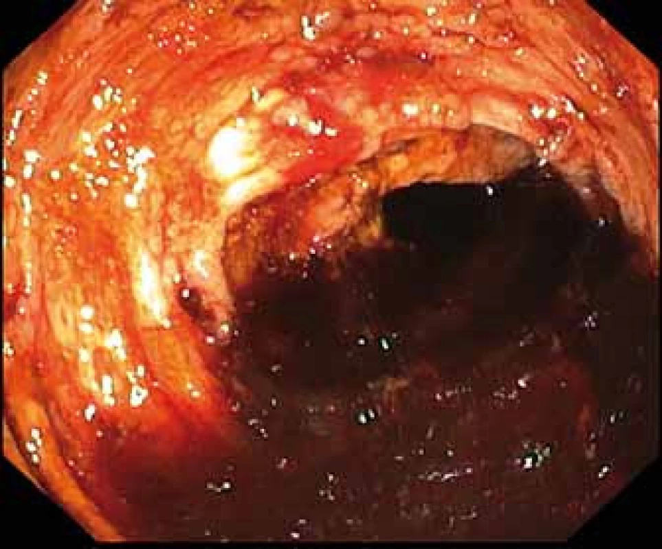 Pohled do lumen colon ascendens – kompletně vyplněné krví a koaguly.<br>Fig. 2. Lumen of the ascending colon – completely filled with blood and coagulum.