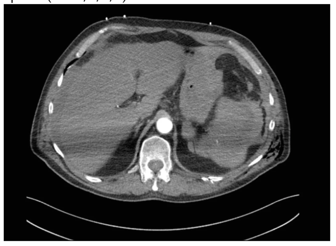 CT trupu po KPR. Transversální řez. Ruptura sleziny s hemoperitoneem, v arteriální fázi s patrným leakem KL