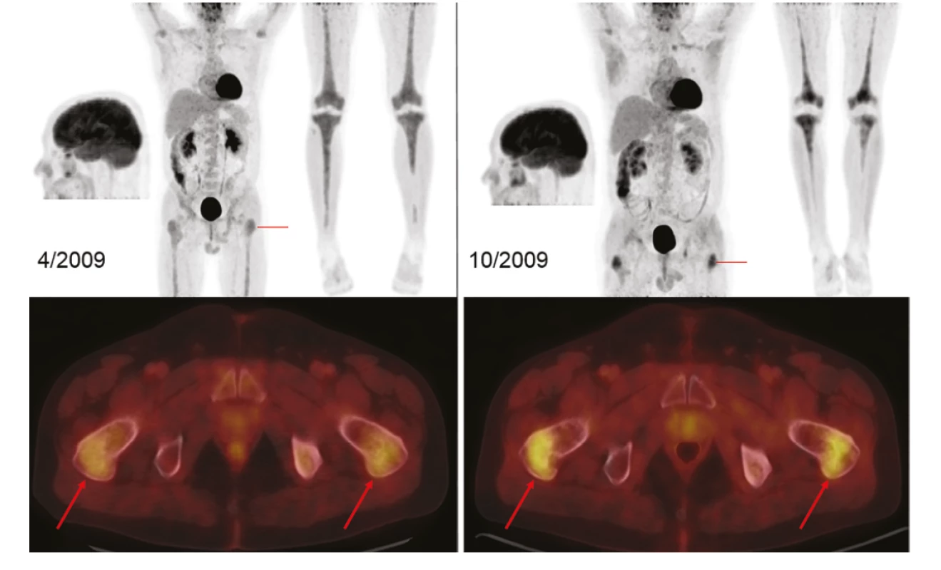 Monitorace léčby nemoci pomocí FDG-PET/CT vyšetření: Vlevo sken při zahájení terapie, MIP projekce hlavy, trupu i dolních končetin (v černobílé
barevné škále). V místech označených červeně jsou doplněny axiální fúzované řezy (v barevné škále Hot Body), s detaily FDG-avidního postižení proximálních
stehenních kostí (šipky). Vpravo pak identické skeny, které prokazují nárůsty akumulací FDG ve stehenních kostech, tibiích i maxille. Akumulace FDG
v mozku, ledvinách, močovém měchýři je fyziologická. Akumulace v myokardu, vzestupném tračníku je variantou fyziologického zobrazení
