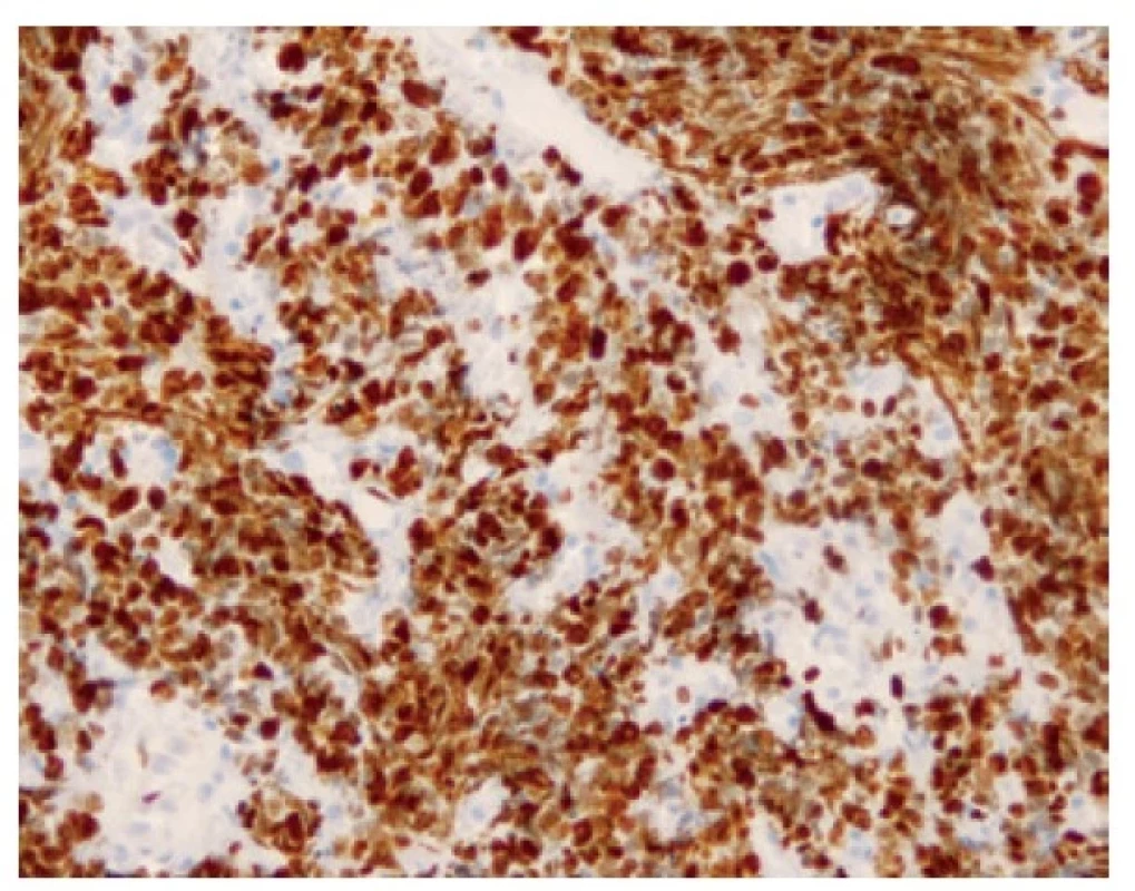 Přibližně 95 % buněk pozitivních v imunohistochemickém průkazu
proliferačního antigenu Ki-67. 200x.