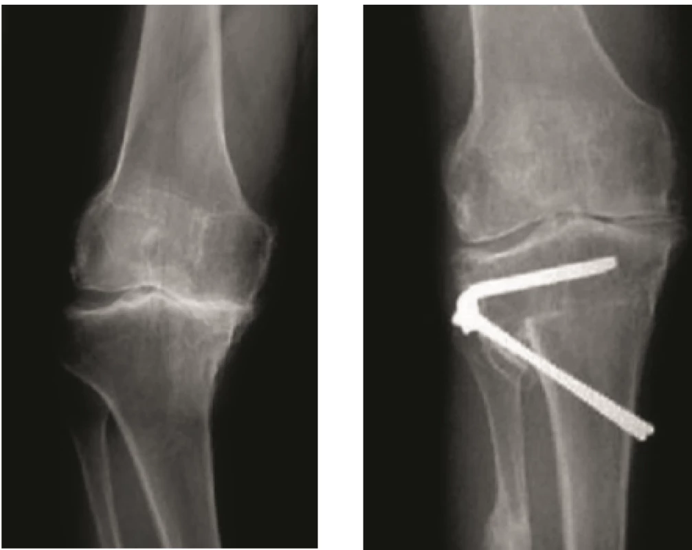 RTG snímky kolena s artrózou mediálního kompartmentu v předozadní projekci před a po osteotomii (převzato z 1).