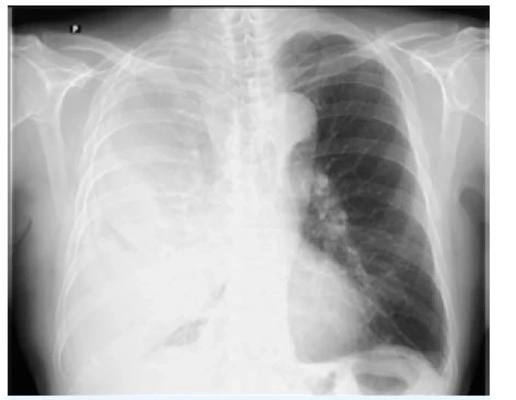 Rozsáhlý parapneumonický výpotek
