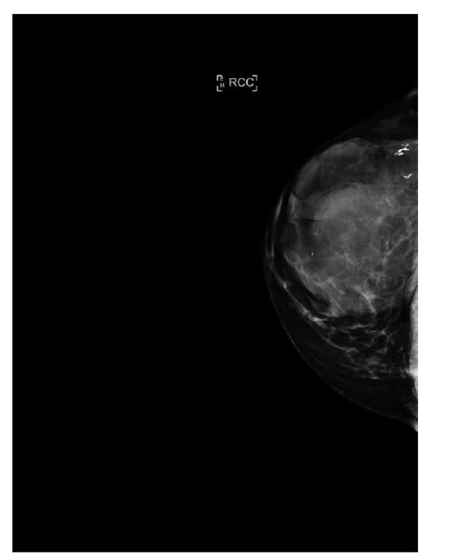 Mamograf, kraniokaudální projekce, primární tumor.<br>
Fig. 2: Mammogram, craniocaudal projection, primary
tumor.