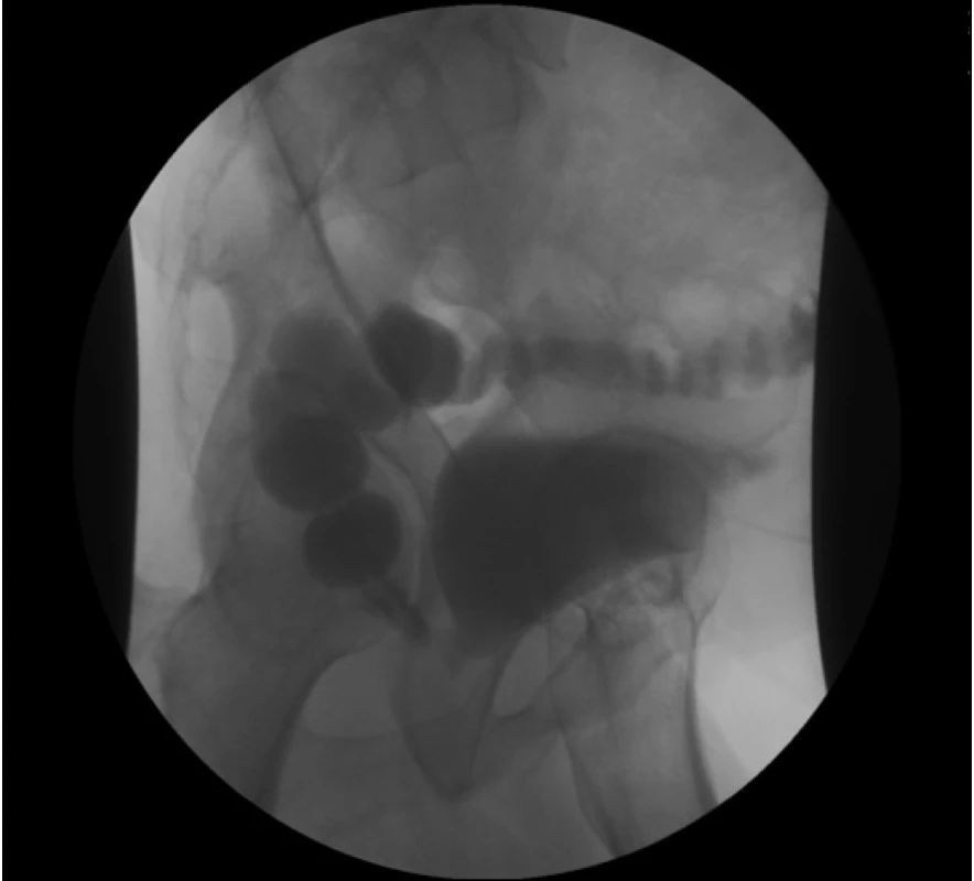 Průkaz rektoanastomotické píštěle uretrocystografií<br
Fig. 1. Diagnosis of the rectoanastomotic fistula on
urethrocystography