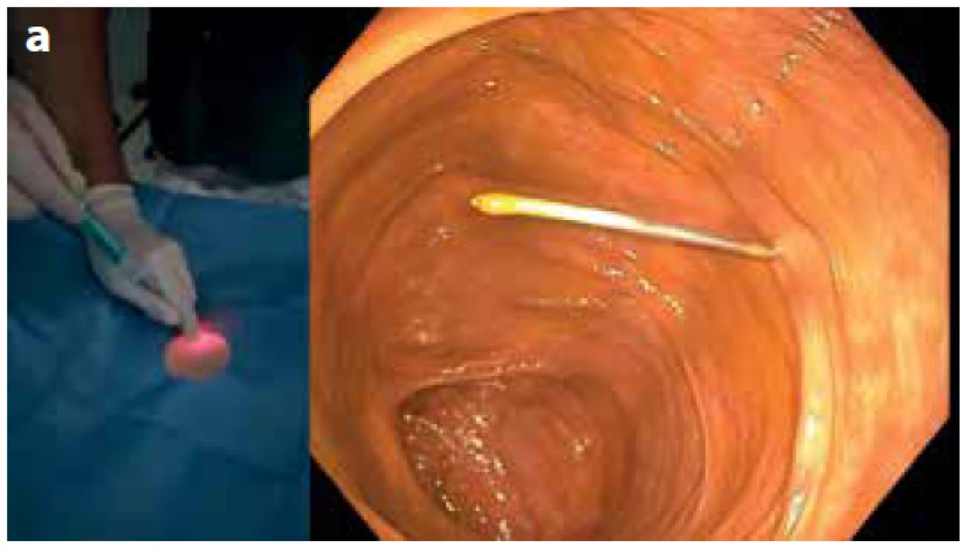 a: Punkce céka jehlou obsahující kotvicí systém
(vlevo); koloskopický pohled (vpravo)<br>
Fig. 2a. Cecal puncture with a needle containing an anchoring
system (left); colonoscopic view (right)