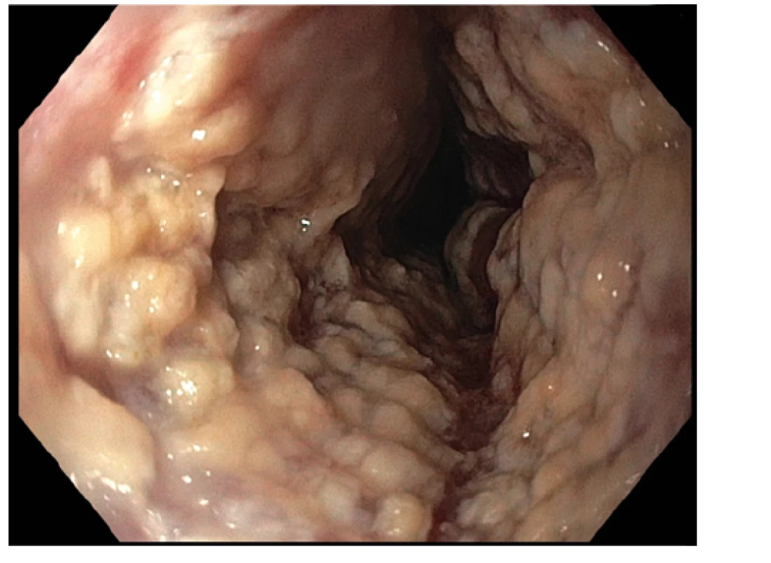 Endoskopický obraz těžké mykotické infekce. Fotografie z proximálního
jícnu