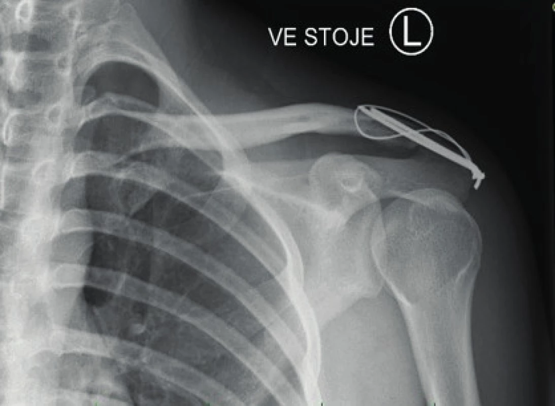 X-ray image of Rockwood type III AC dislocation – fixation using K-wires with traction cerclage