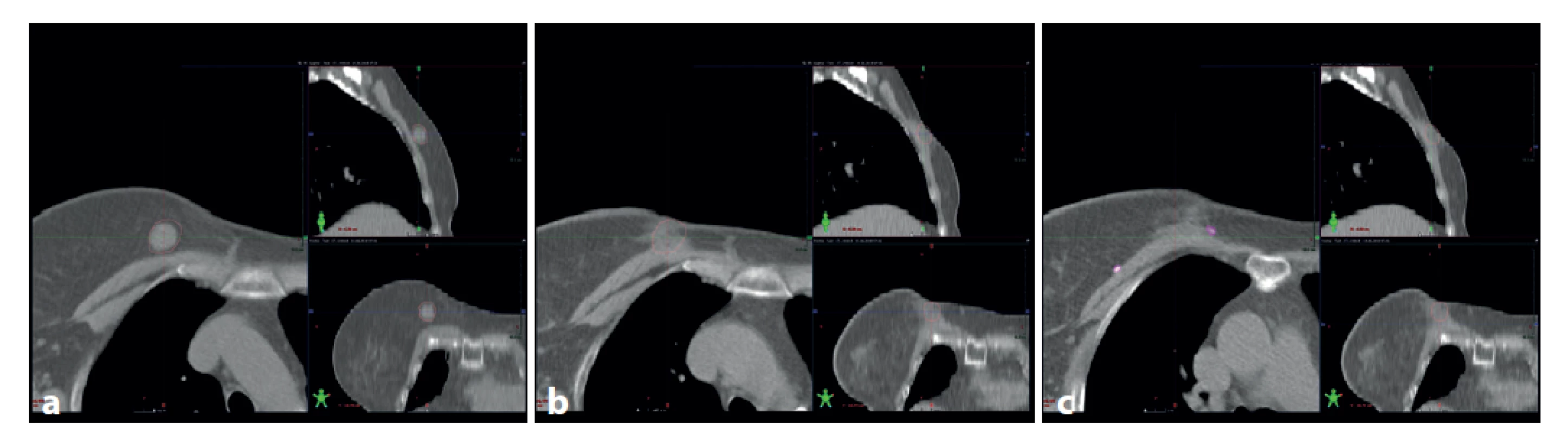 : a – předoperační CT s tumorem (konturován hnědě), b – pooperační CT ve stejné lokalizaci, c – pooperační CT v oblasti
s metalický klipy v lůžku tumoru (hnědě kontura původní lokalizace tumoru)<br>
Fig. 2: a – preoperative CT, tumor contoured brown; b – postoperative CT in the same location; c – postoperative CT with
metallic markers in the postlumpectomy cavity (original tumor site contoured brown)