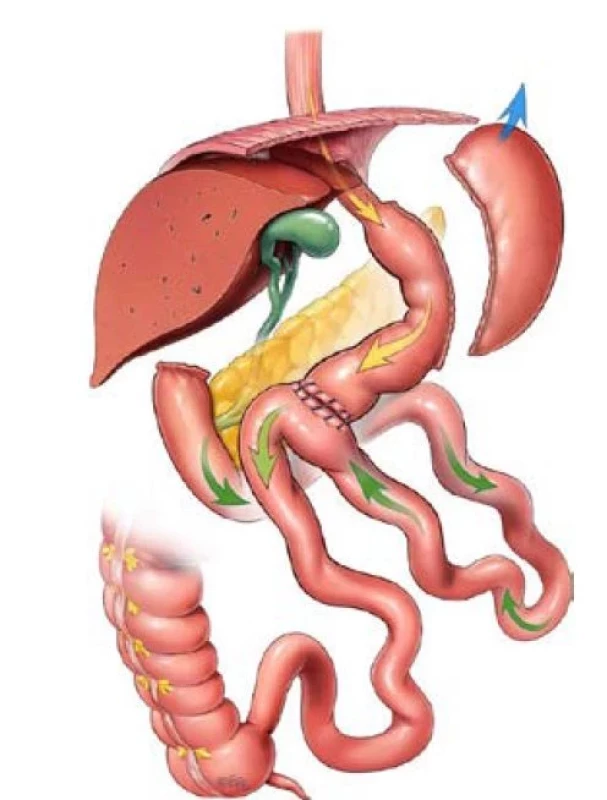 Tubulizace žaludku spojená s duodenojejunálním bypassem