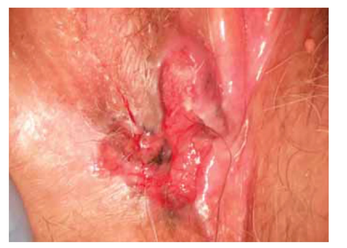Pigmentovaná léze vulvy.<br>
Fig. 6. Vulvar pigmented lesion.