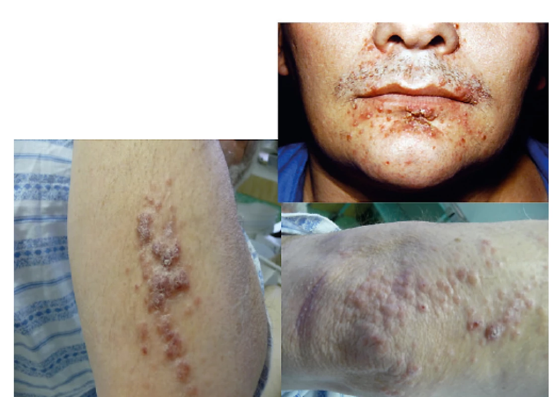 LCH infiltruje často zapářkové intertriginozní oblasti, ale může
se objevit i na obličeji a na paži<br>
Makroskopicky může připomínat folikulitidu a jedině histologické
vyšetření excise kůže může správně stanovit diagnózu. U špatně
se hojících či nehojících se kožních morf je proto na místě vždy
histologická verifikace kožního onemocnění.