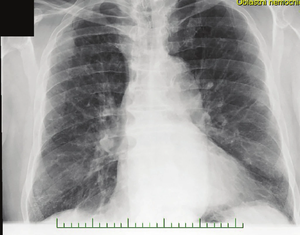 Suspektní metastázy na RTG snímku před provedením
PET/CT hrudníku<br>
Fig. 3: Native X-ray image of the lungs with suspected metastasis
before PET/CT of the trunk