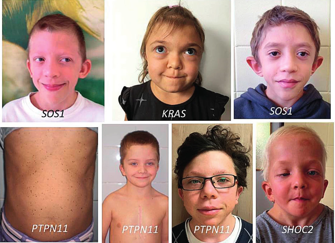 Příznačný faciální fenotyp spojený s jednotlivými kauzálními geny.<br>
Fig. 8. Typical facial phenotypes in children with individual causative genes.