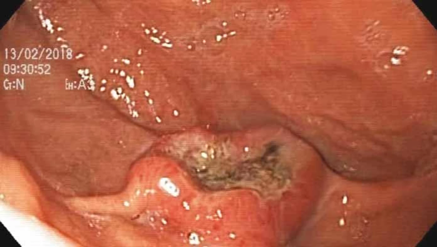 Exulcerovaný tumor fundu žalúdku v nomálnom svetle.<br>
Fig. 1. Exulcerated tumour of the stomach fundus in normal light.