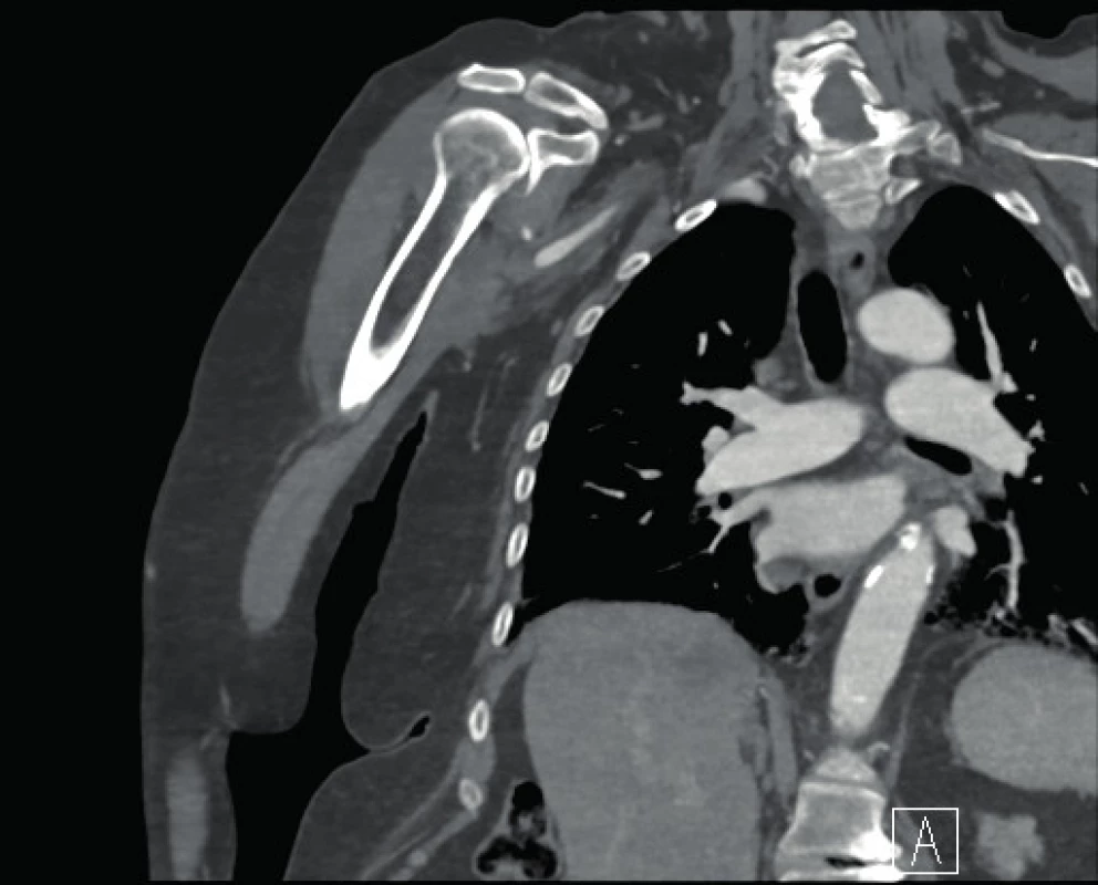 SCT angiografické vyšetření s nálezem uzávěru a. axillaris
a a. brachialis vpravo
