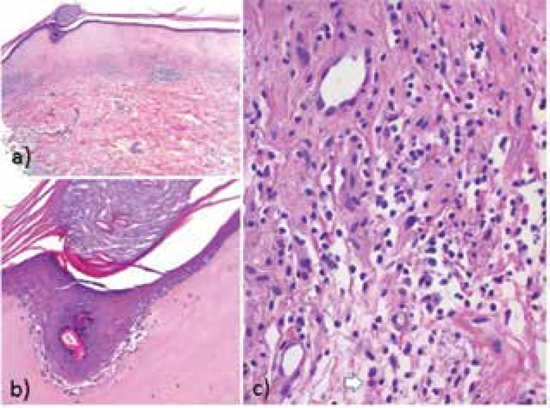 Typický histopatologický obraz LS zahrnuje atrofickou
epidermis krytou folikulárně akcentovanou hyperkeratózou se
známkami vakuolární degenerace bazální vrstvy (b) s inkontinencí pigmentu. V koriu, subepidermálně, je pruh eozinofilně
homogenizovaného kolagenu s  ojedinělými melanofágy, pod
kterým je patrný pás intersticiálního a perivaskulárního mononukleárního infiltrátu (a), s ojedinělými eozinofily – bílá šipka (c)
