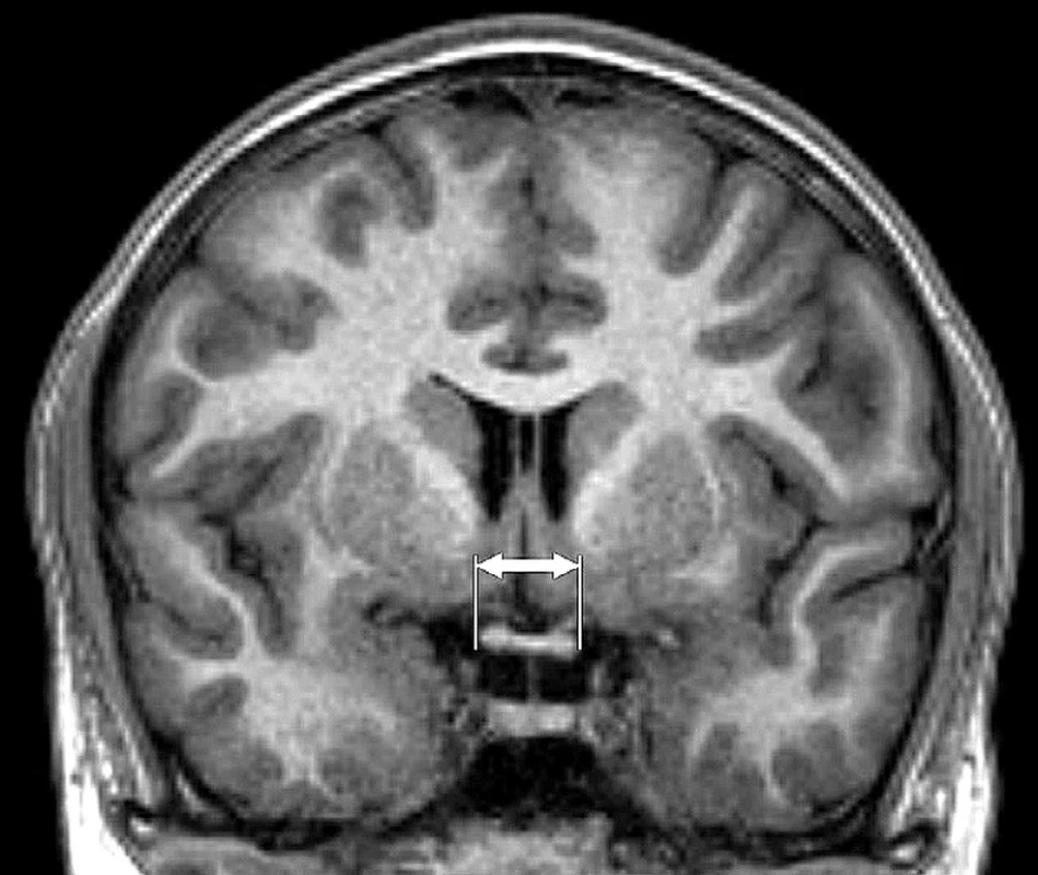  Magnetic resonance, coronal reconstruction T1 TFE image. Measurement of horizontal dimension of chiasm (indicated by arrows)