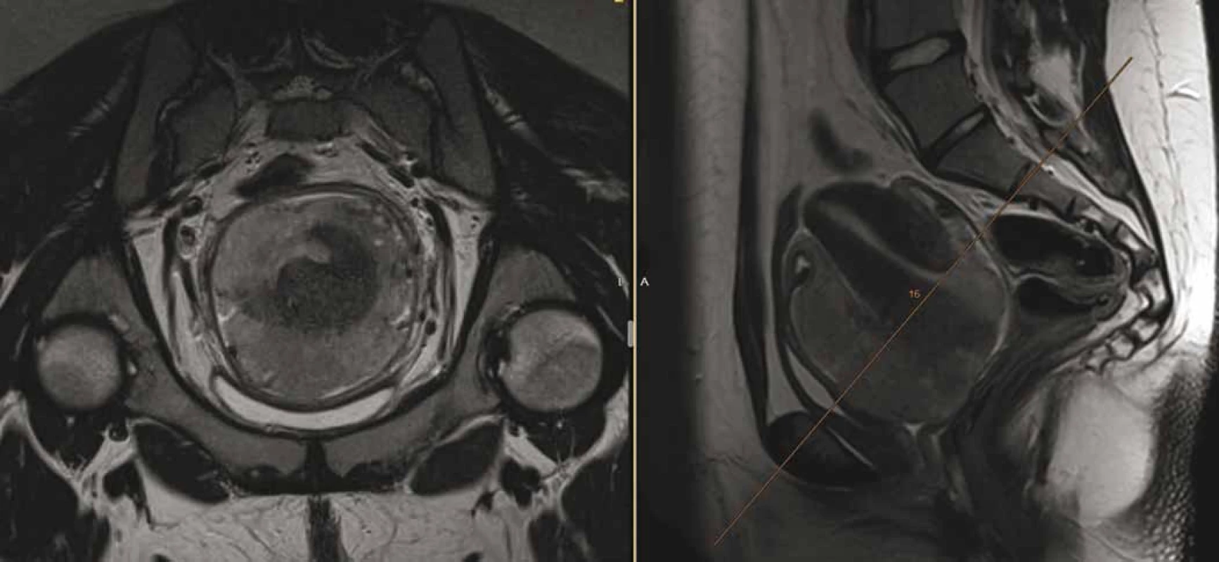 Magnetická rezonance pánve odhalující tumor velikosti 80 × 90 × 80 mm, vycházející z oblasti děložního hrdla, de facto
obdávající dělohu, vyplňující pochvu, naléhající na močový měchýř a rektum (bez zřetelné invaze), lymfadenopatie presakrálně
(30 × 15 × 15 mm) a bilaterálně parailicky (28 × 21 × 40 mm).