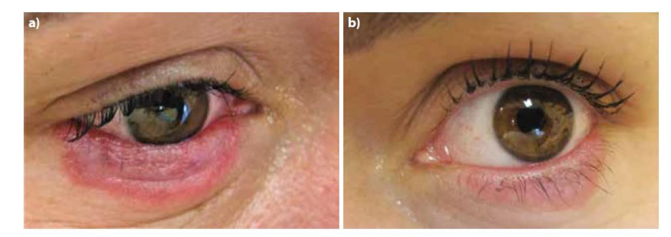Postižení pravého (1a) a levého (1b) očního víčka při prvním vyšetření