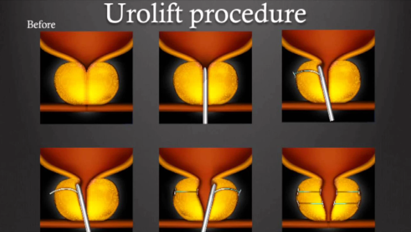 Schéma průběhu aplikace systému UroLift®<br>
Fig. 2. UroLift® application flow diagram
