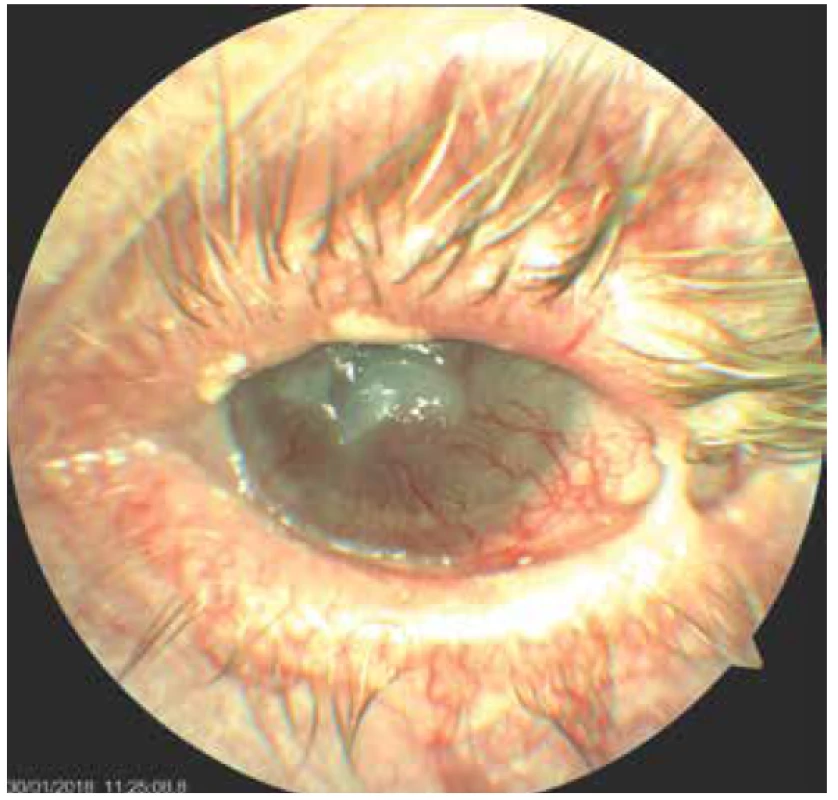 Levé oko pacientky- počínající lýza rohovkového
leukomu, stav po parciální tarsorafii, oko drážděno