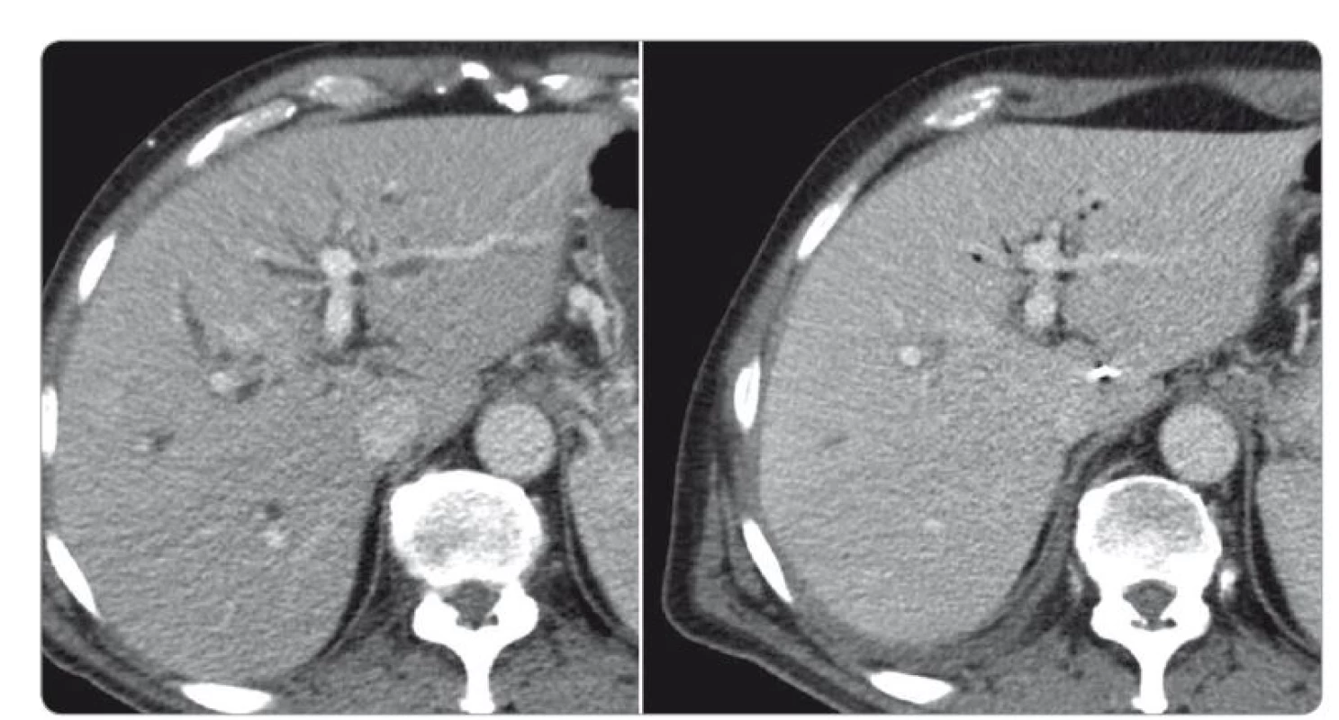 CT břicha před a po léčbě kortikosteroidy, transverzální řezy.