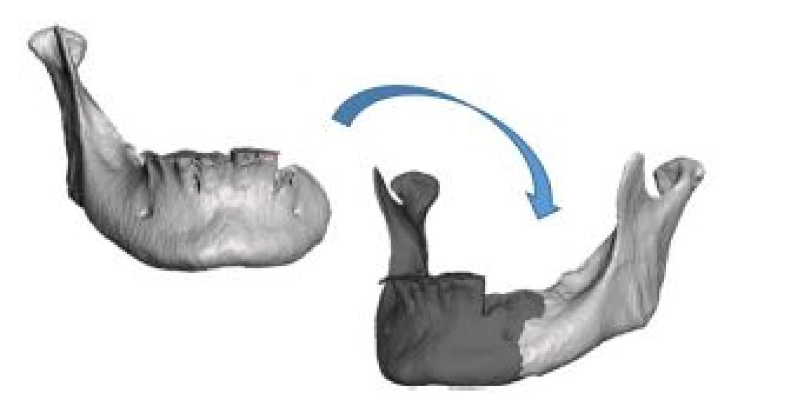 Mirror-based reconstruction approach for the design of the mandibular implant.